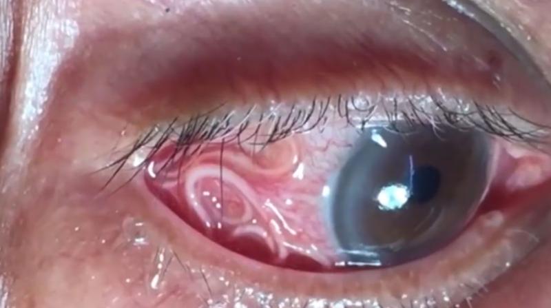 Gusanos oculares