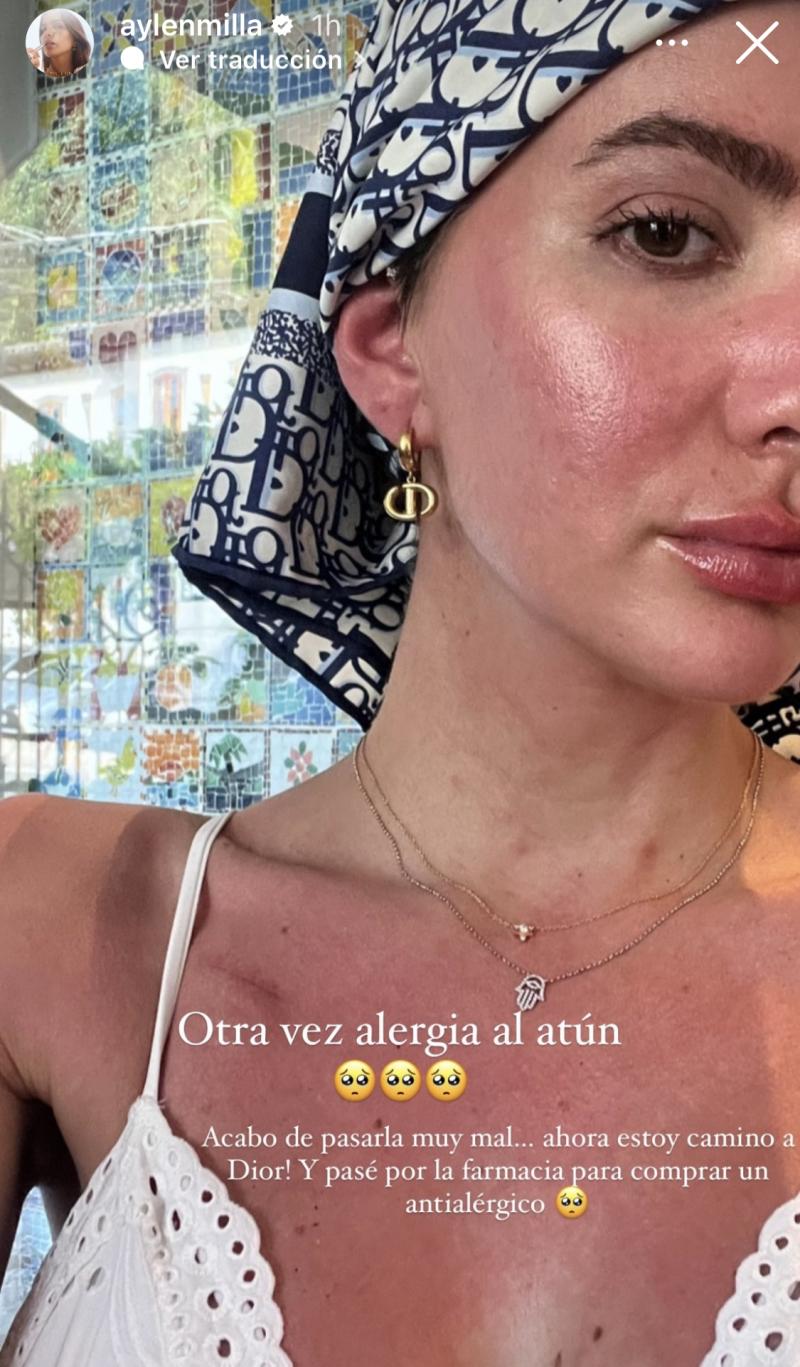 Aylén Milla sufre reacción alérgica por comer atún