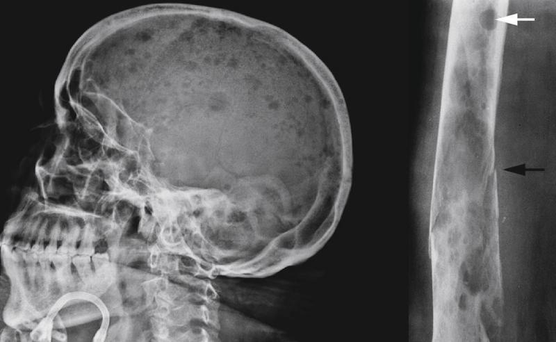 Mieloma múltiple, el cáncer silencioso