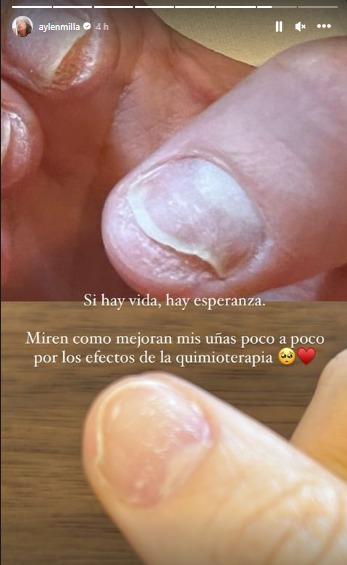 Aylén Milla reveló complejas consecuencias de quimioterapias en su cuerpo