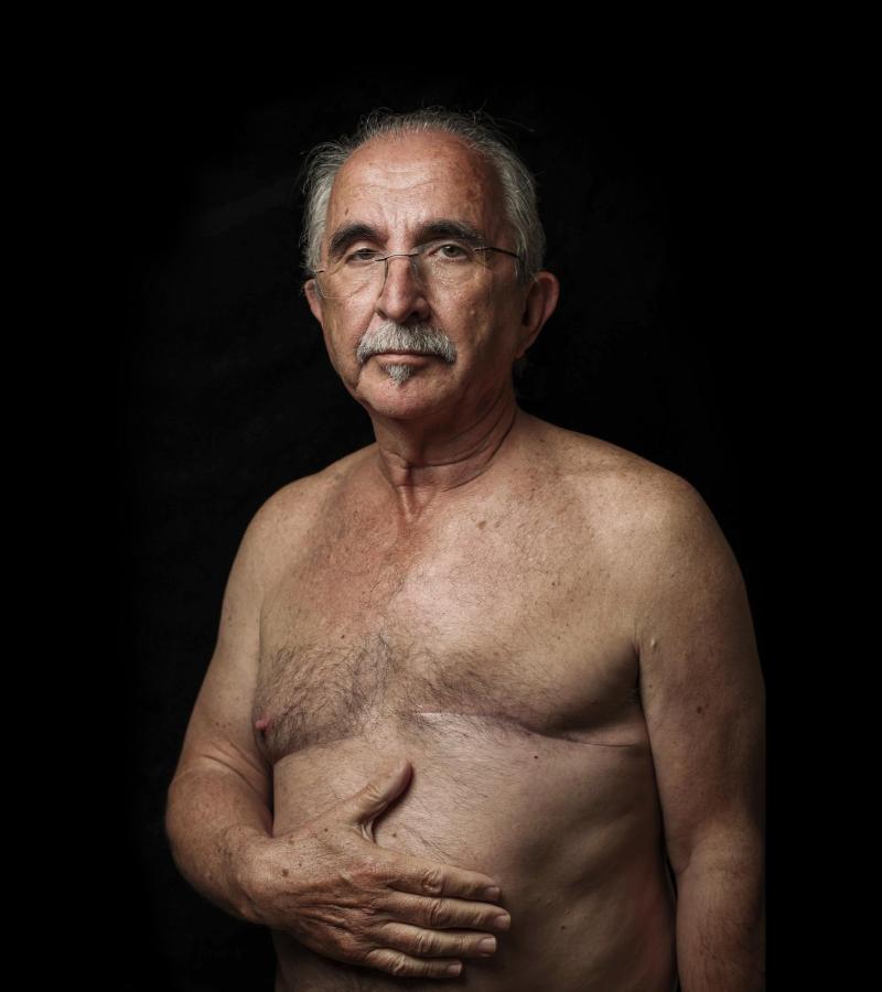 Cáncer de mama en hombres