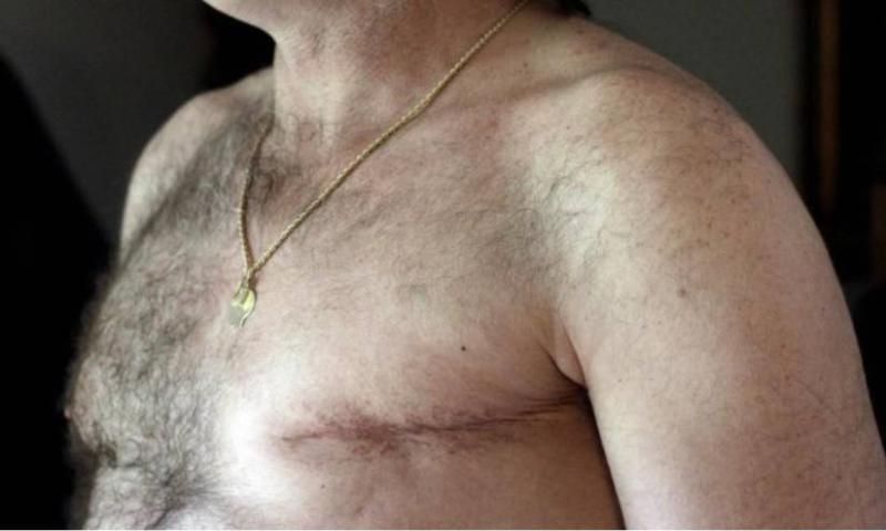 Cáncer de mama en hombres