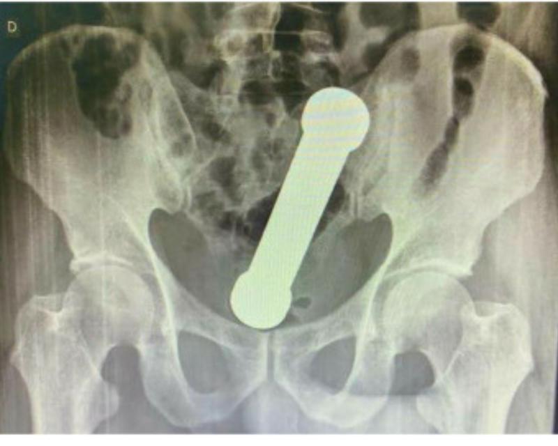 No quería cooperar: encuentran mancuerna de dos kilos en cuerpo de hombre que alegaba dolor de estómago