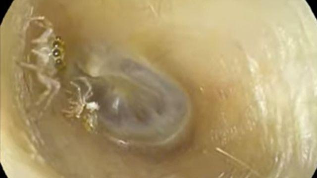 Araña saltarina en el oído de una mujer