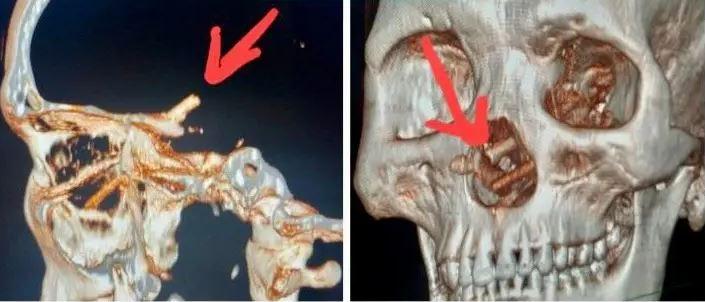 Hombre sufría de dolores de cabeza: doctores encontraron espantosa causa