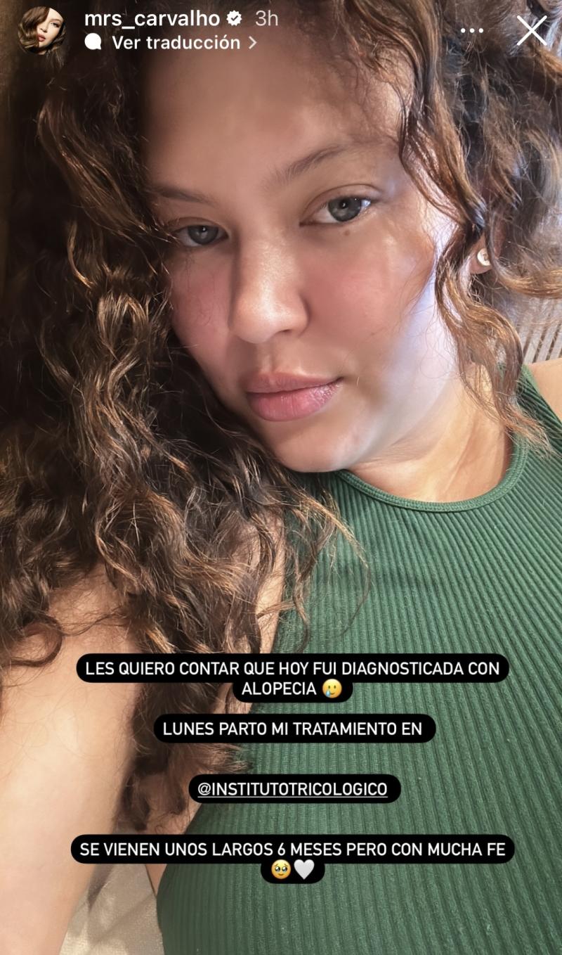 Michelle Carvalho padece de alopecia