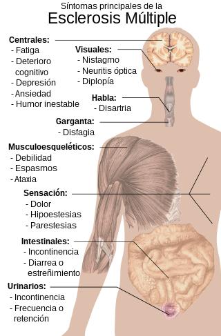 Síntomas de la ELA. Créditos Getty Images