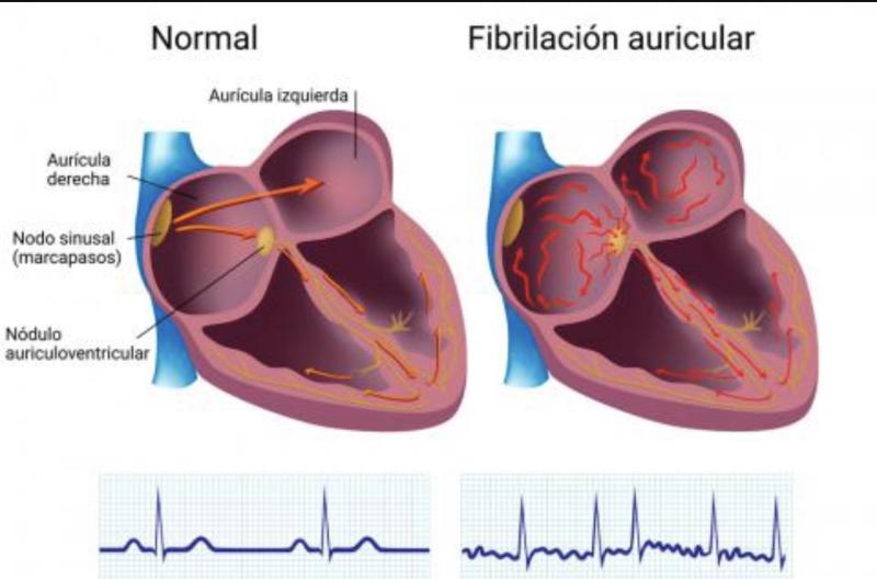 Imagen de referencia de un cerrazón sano y uno con fibrilación auricular