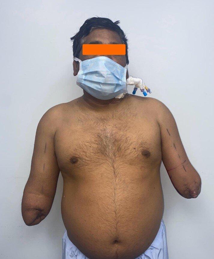 Pintor con sus manos amputadas. Créditos: Atlas