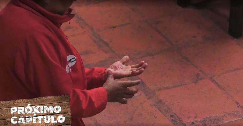 Miguelito muestra su mano accidentada