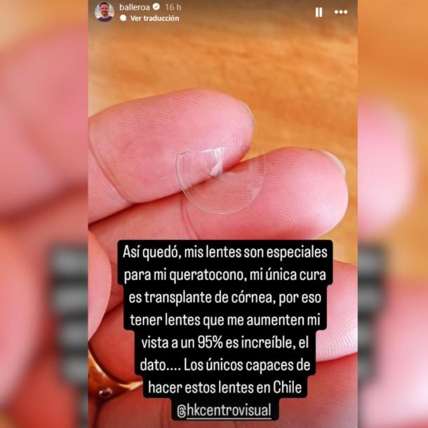 Álvaro Ballero mostró como quedó su lente de contacto | Instagram