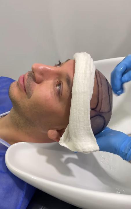 Rodrigo Gallina se sometió a innovador procedimiento de injerto capilar.