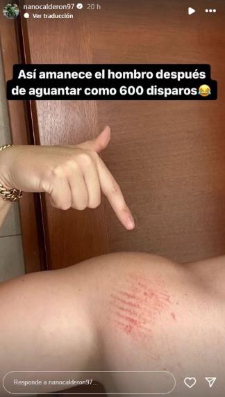 Así quedó el hombro de Nano Calderón.