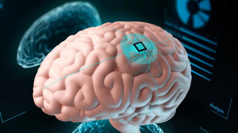 Imagen de referencia del chi instalado en el cerebro. Créditos: Getty Images