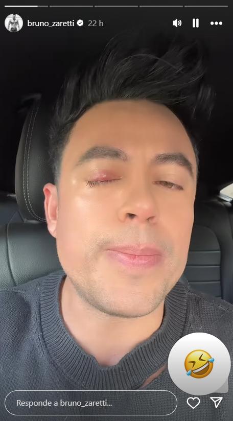 Bruno Zaretti nuevamente se mostró con problemas en su ojo.