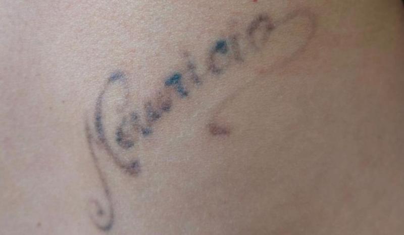 Tatuaje borrado de Gisella Gallardo