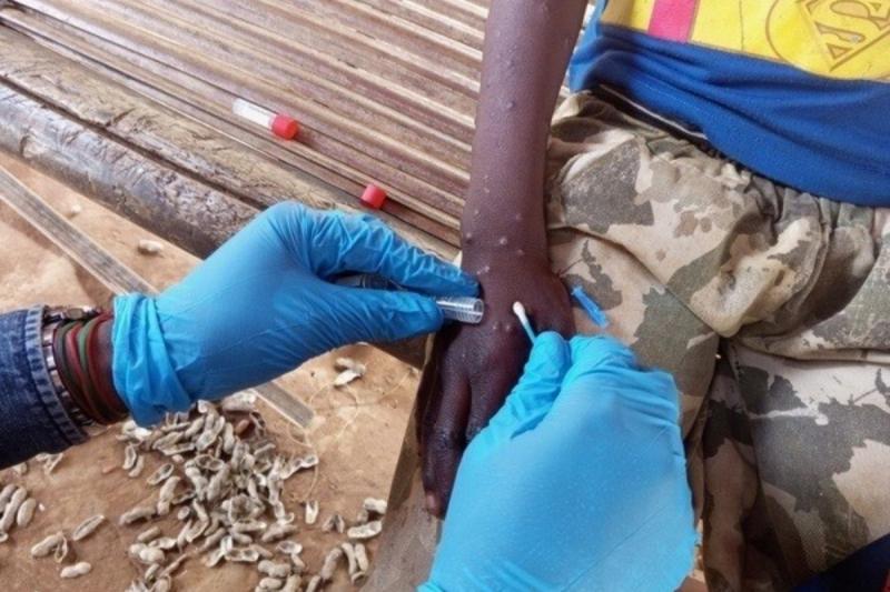 Síntomas de la Viruela del Mono - Créditos: ATON