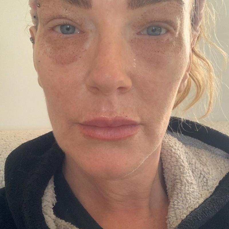 Catalina Pulido mostró la evolución del procedimiento estético al que se sometió por "razones médicas"