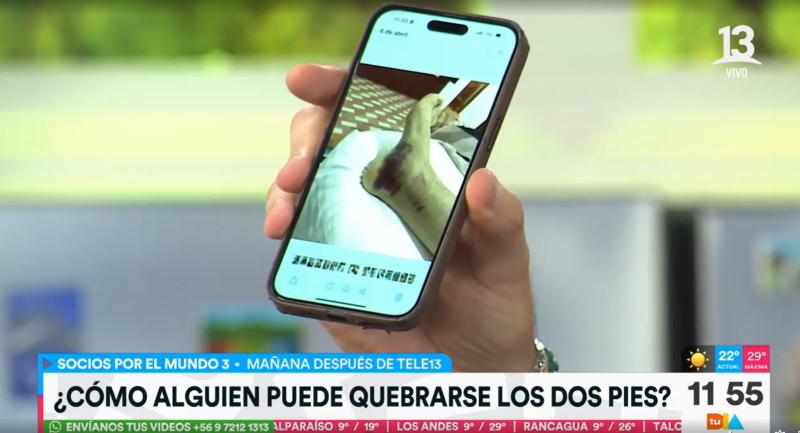 Así quedaron los pies de Pancho Saavedra tras sufrir una caída mientras grababa "Socios por el Mundo"