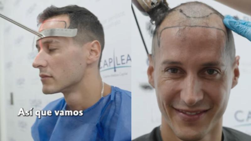 Mel Alcalde se sometió a una cirugía de implante capilar.