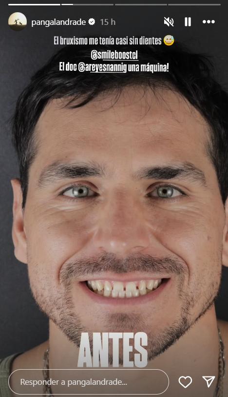 Pangal Andrade se sometió a importante cambio en su sonrisa.