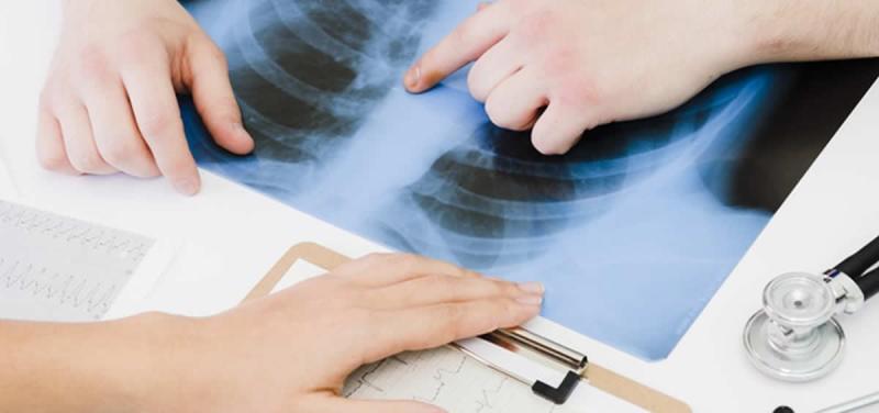 El enfisema pulmonar es un tipo de enfermedad pulmonar obstructiva crónica, conocida como EPOC.