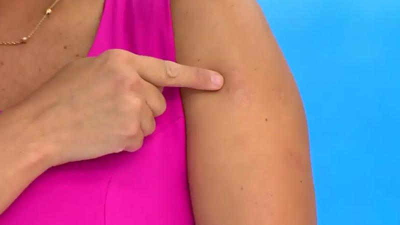 La cicatriz del tumor de Priscilla Vargas