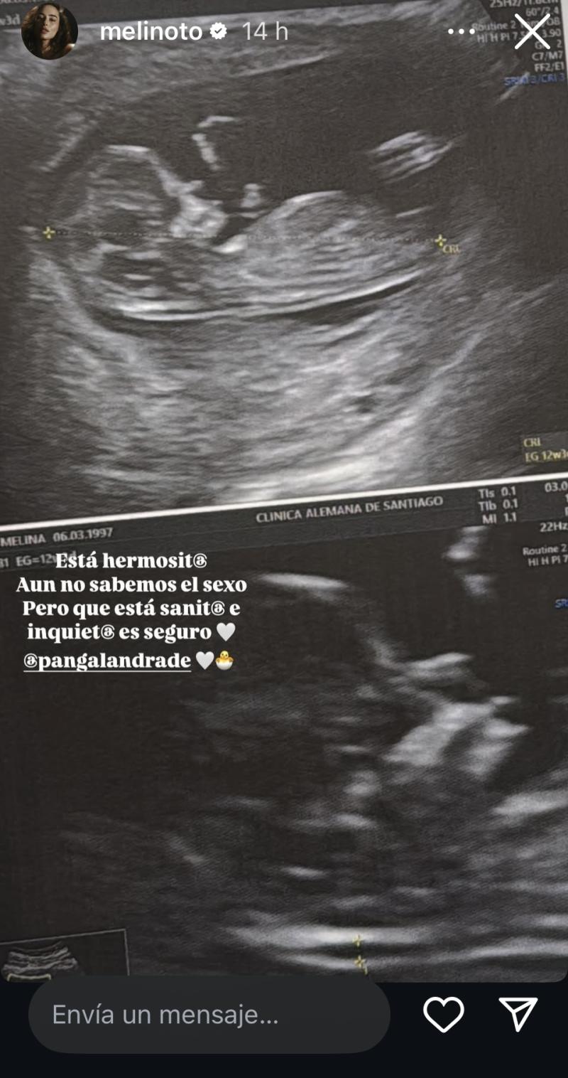 Melina Noto comparte ecografía de su bebé con Pangal Andrade - Instagram