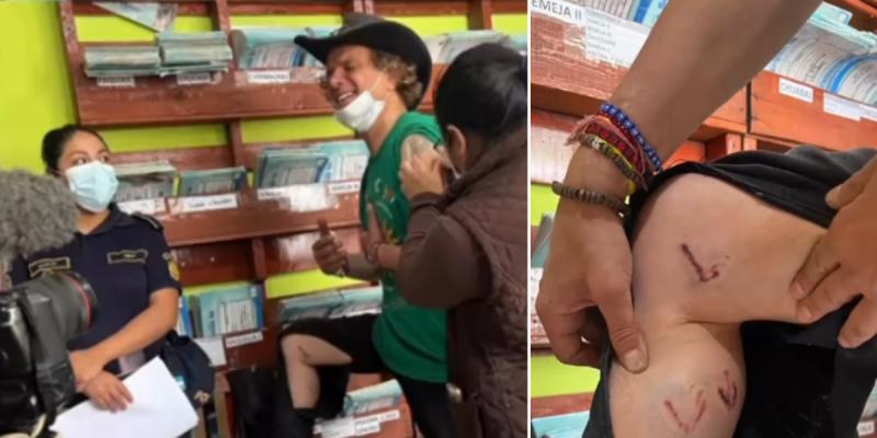 Jorge Said muestra heridas que recibió tras ataque de jauría durante filmación de "Secretos de un reportero". Créditos: Instagram.