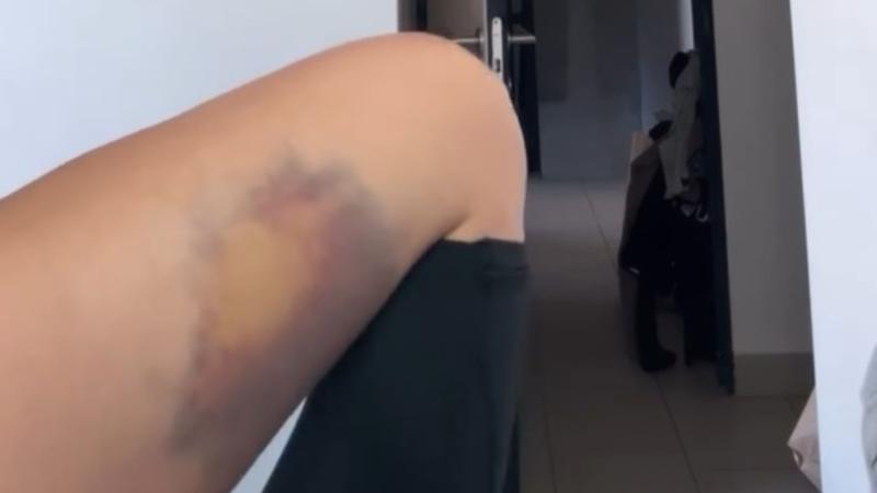 La lesión de Faloon Larraguibel