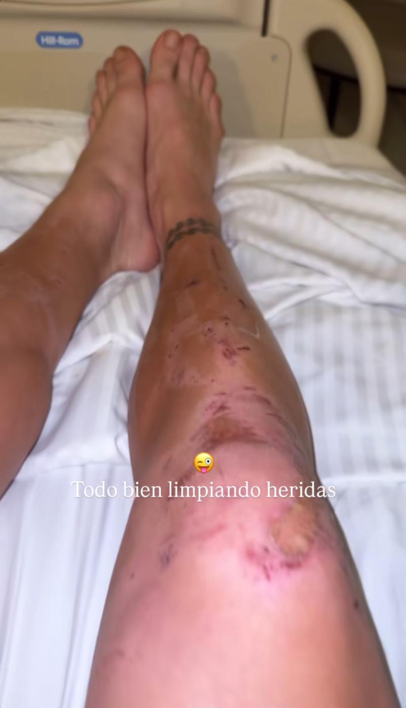 Las lesiones de Rai Cerda tras la final de "Palabra de Honor"