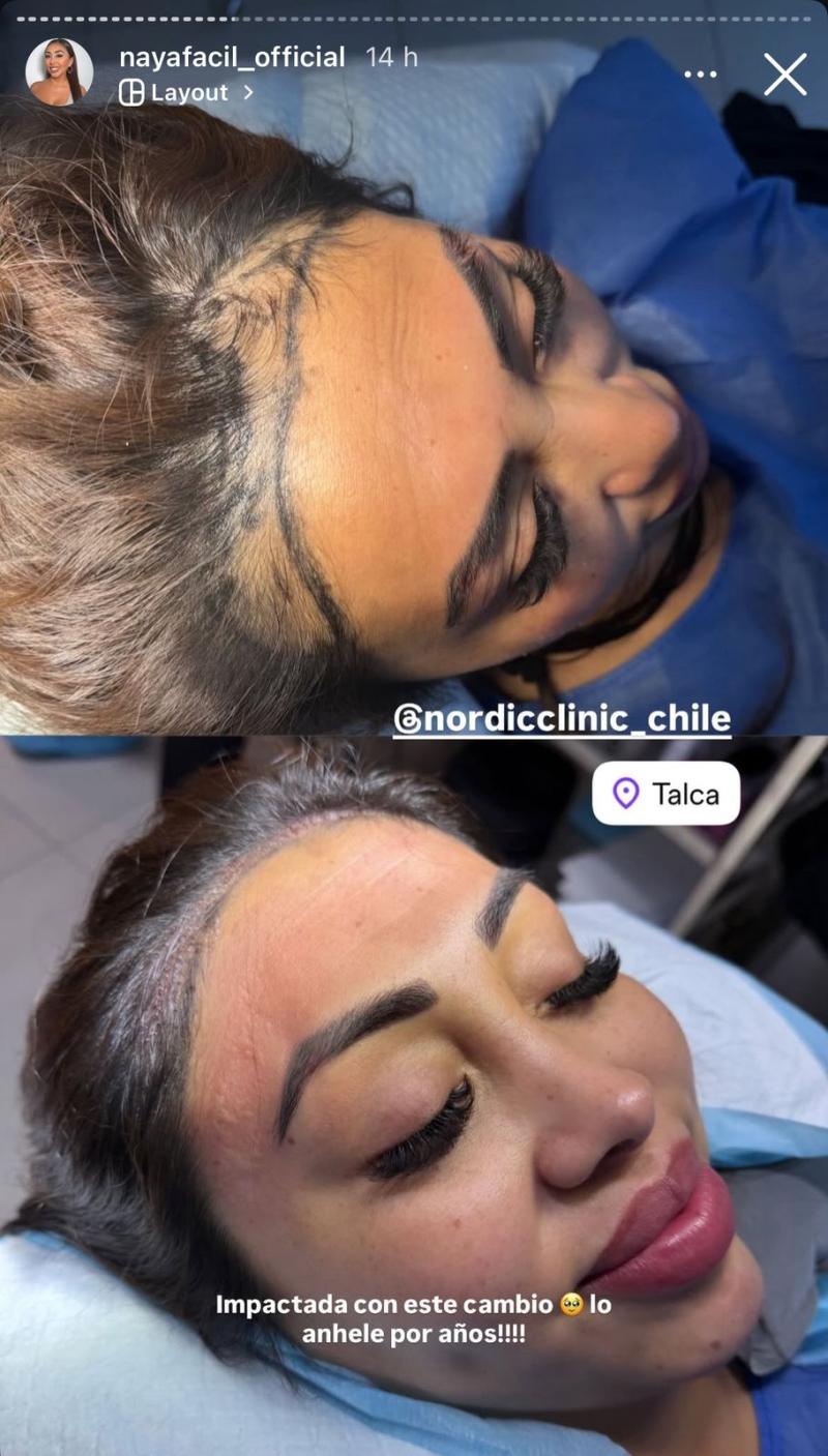 Así quedó Naya Fácil luego de realizar injerto de cabello - Instagram