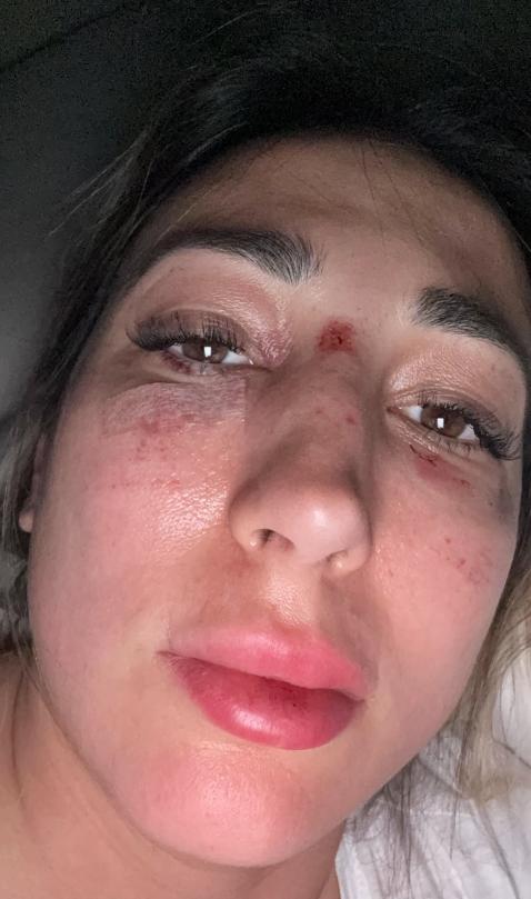 Así quedó el rostro de Rebeca Naranjo, novia de Nano Calderón, tras accidente - Instagram