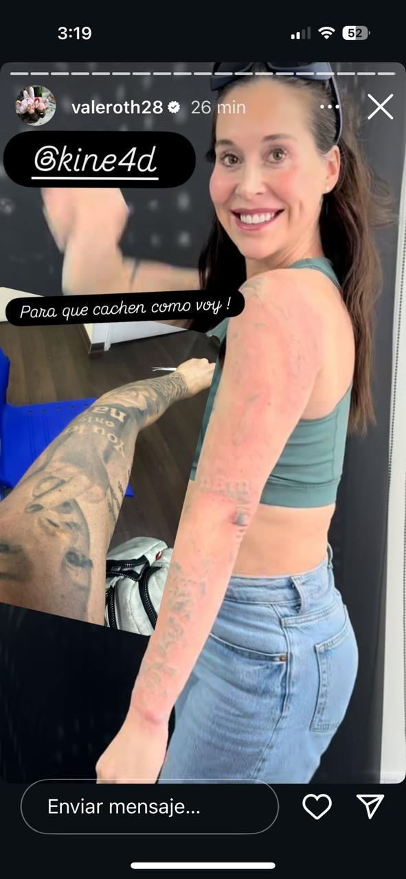 Borrado de tatuaje de Vale Roth | Instagram