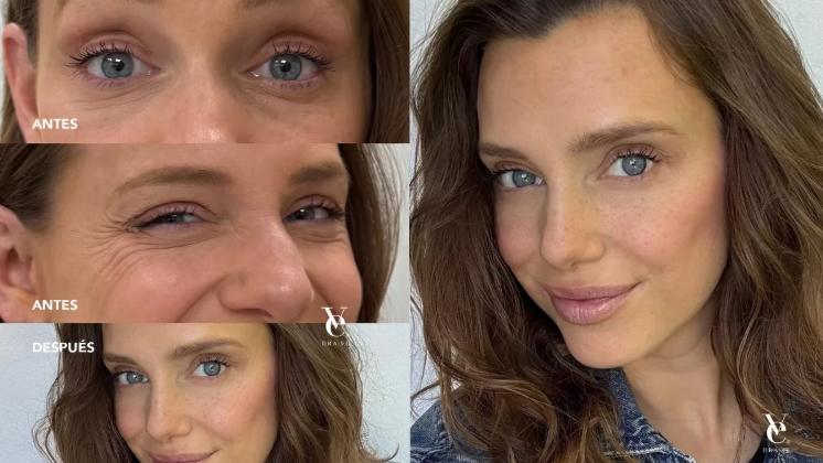 Emilia Daiber se sometió a procedimiento estético - Instagram