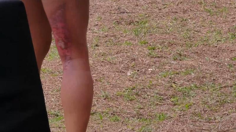 Así quedó la pierna de Evelyn Ortiz