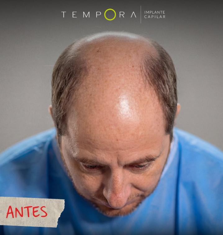 Coke Hevia previo al implante capilar | Instagram