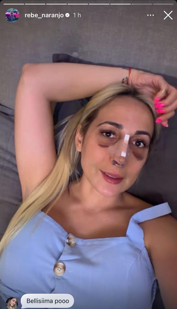 Rebeca Naranjo, novia de Nano Calderón, muestra avances de su operación - Instagram