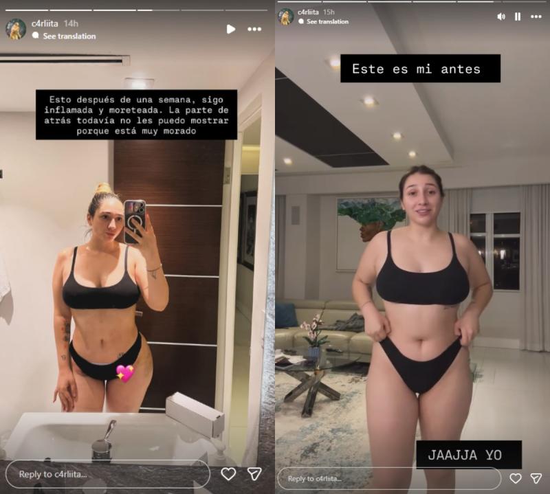 Carlita Inostroza muestra su cuerpo a una semana de millonaria cirugía | Instagram