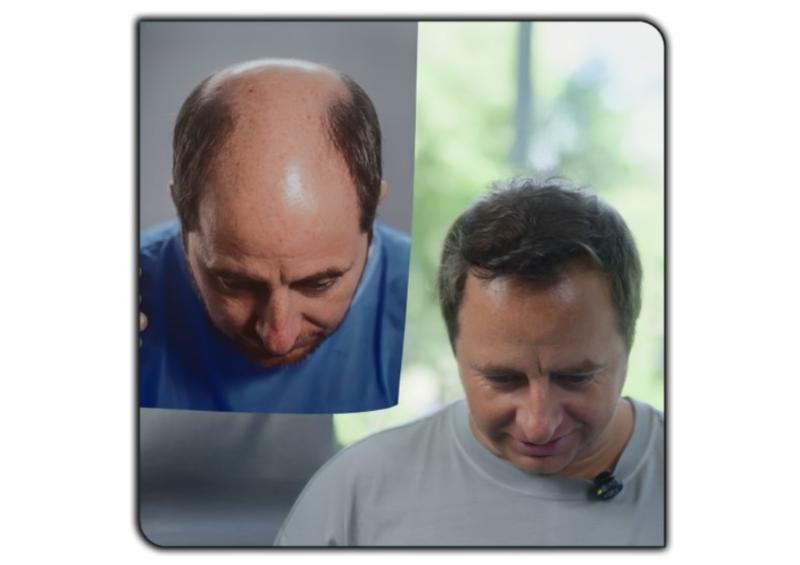 Injerto capilar de Coke Hevia