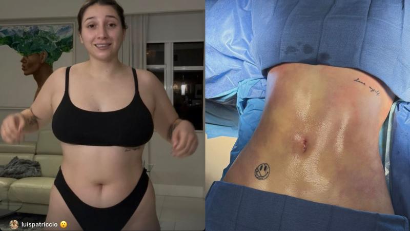 Carlita Inostroza muestra antes y después de su cirugía estética - Instagram