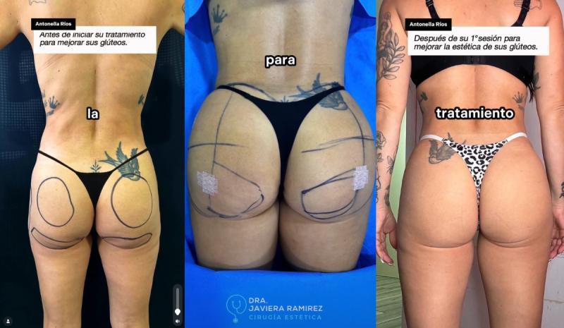 Antonella Ríos muestra los resultados de una intervención estética en sus glúteos | Instagram
