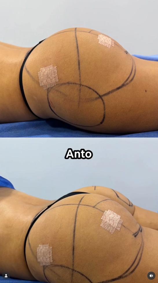 Antes y después de la intervención estética de Antonella Ríos | Instagram