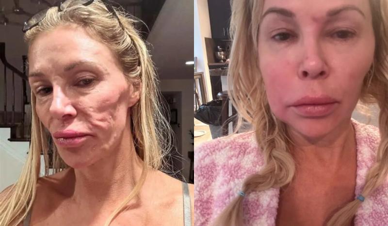 Brandi Granville sufrió una deformación facial causada por implantes mamarios | Instagram & X