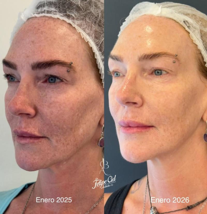 Catalina Pulido muestra un impresionante cambio en su rostro tras procedimiento estético | Instagram