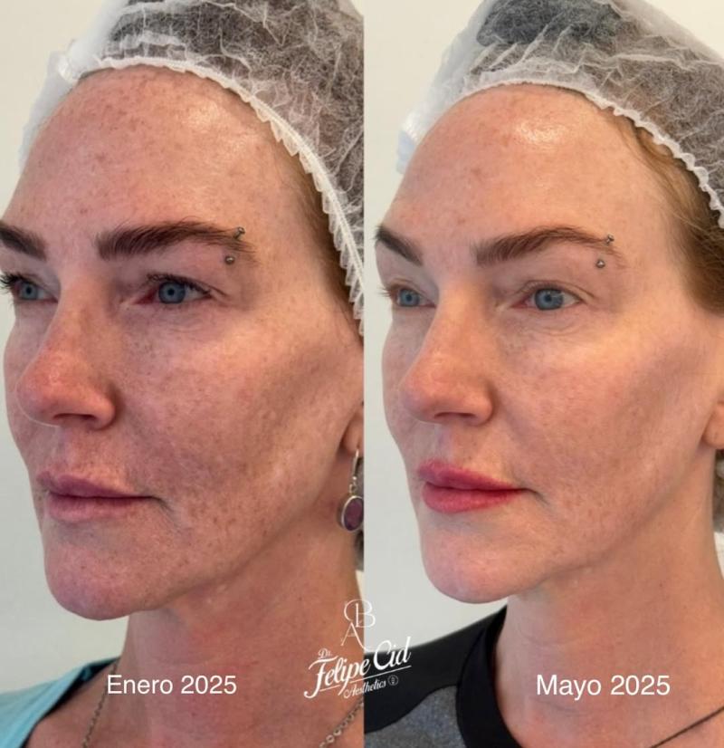 Catalina Pulido muestra un impresionante cambio en su rostro tras procedimiento estético | Instagram