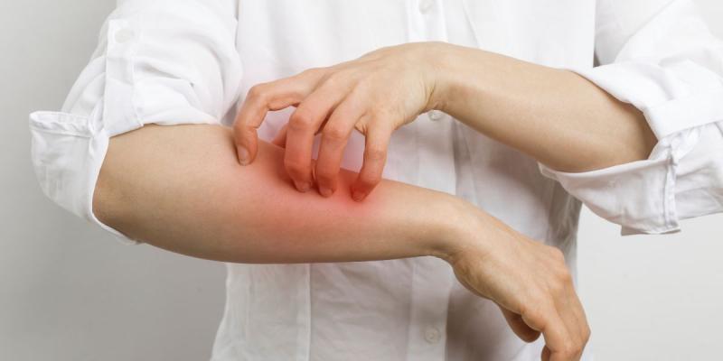 Tras brote de sarna Noruega en Antofagasta: qué es y cómo se transmite la enfermedad