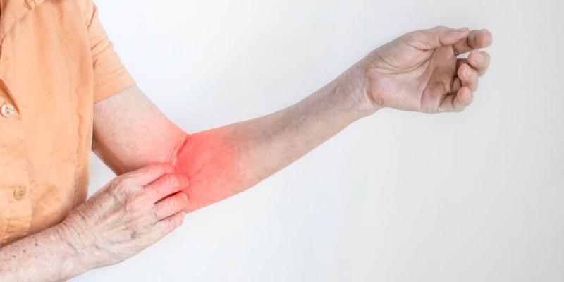 Tras brote de sarna Noruega en Antofagasta: qué es y cómo se transmite la enfermedad