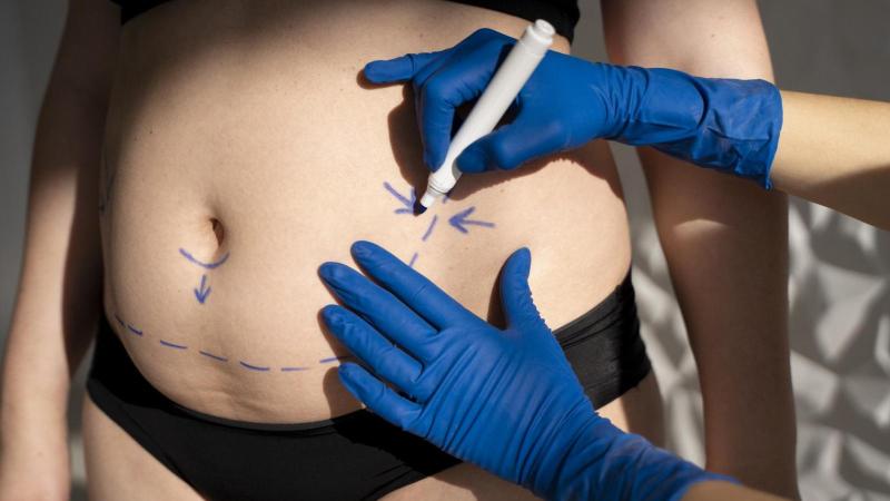 Revisa el valor de la abdominoplastia con el Bono PAD "guatita de delantal"
