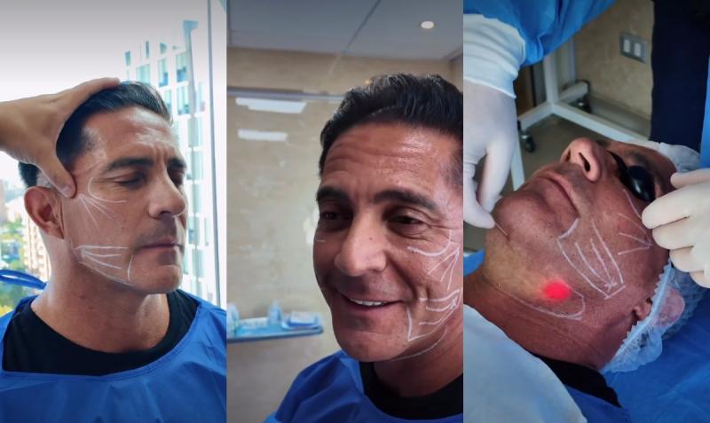 Endoláser facial que se realizó Pato Laguna | Instagram